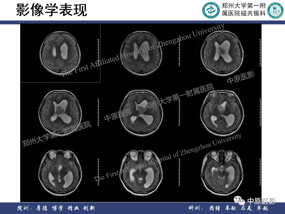 影像PPT - 【病例】侧脑室胶质母细胞瘤1例MR影像-3