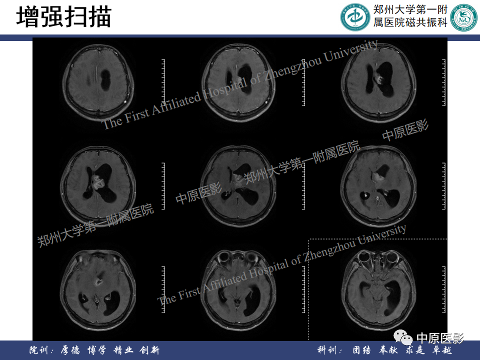 影像PPT - 【病例】侧脑室胶质母细胞瘤1例MR影像-6