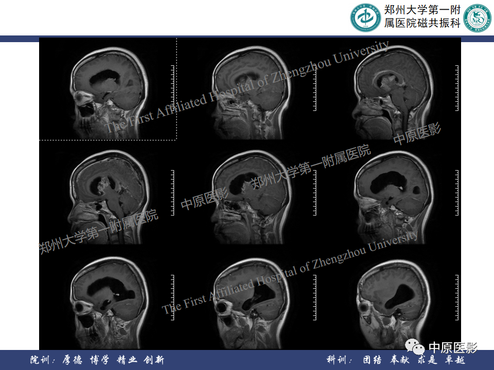 影像PPT - 【病例】侧脑室胶质母细胞瘤1例MR影像-7