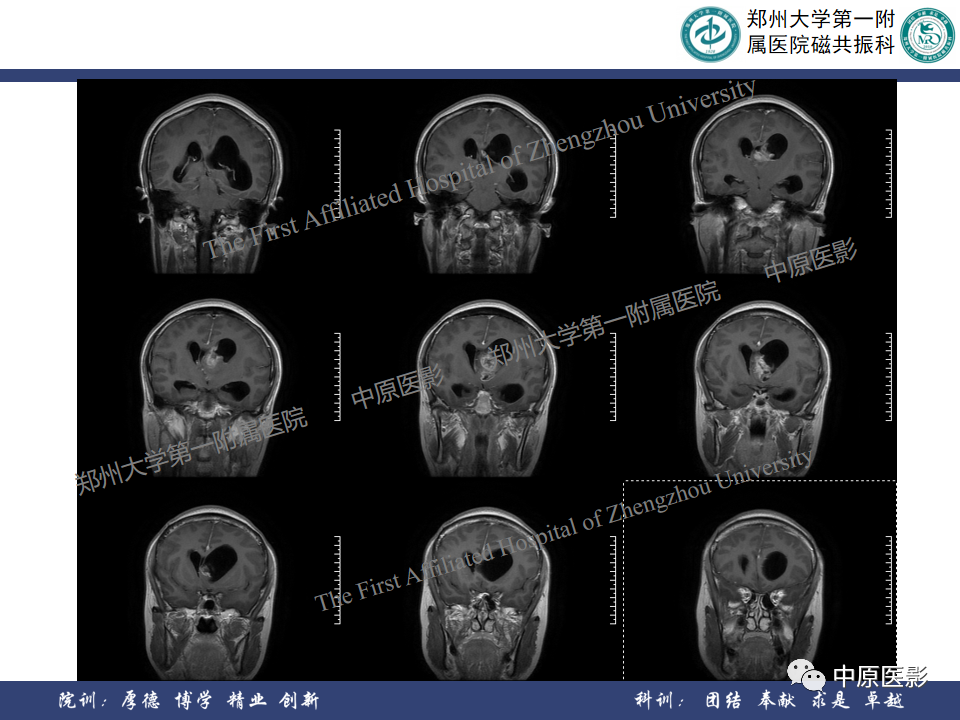 影像PPT - 【病例】侧脑室胶质母细胞瘤1例MR影像-8