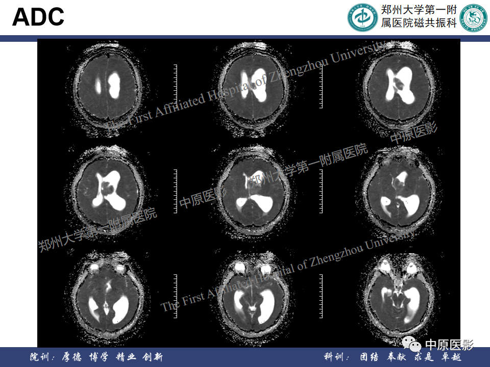 影像PPT - 【病例】侧脑室胶质母细胞瘤1例MR影像-10