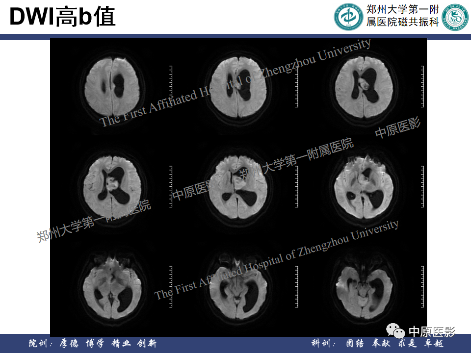 影像PPT - 【病例】侧脑室胶质母细胞瘤1例MR影像-9