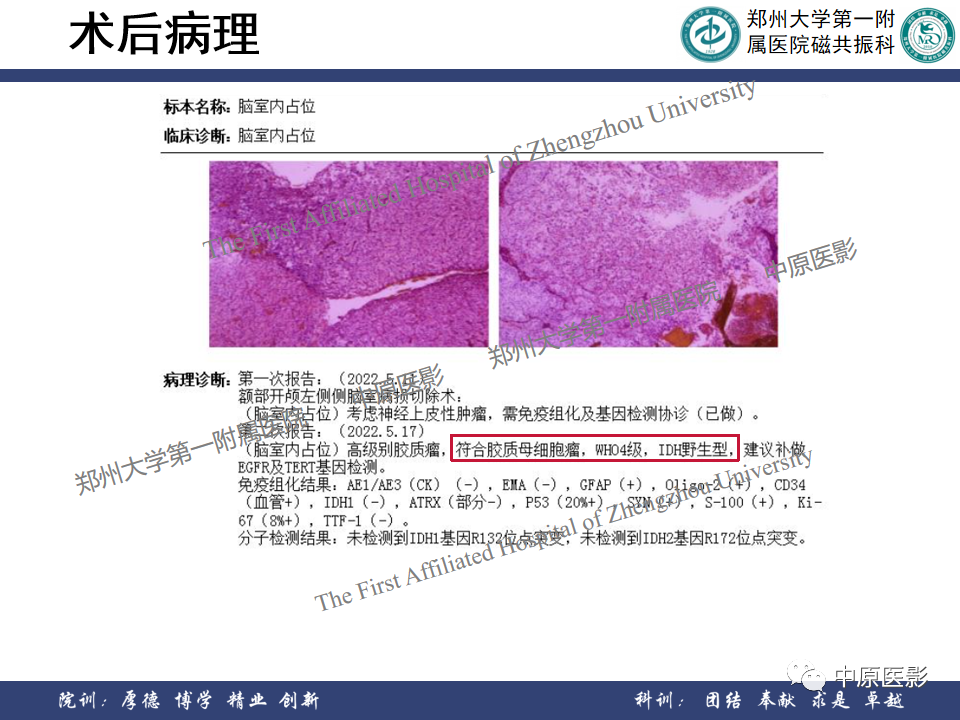 影像PPT - 【病例】侧脑室胶质母细胞瘤1例MR影像-13