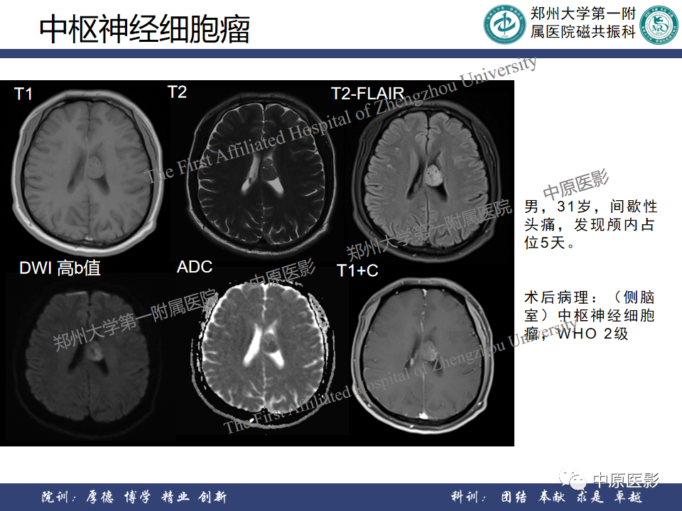 影像PPT - 【病例】侧脑室胶质母细胞瘤1例MR影像-18