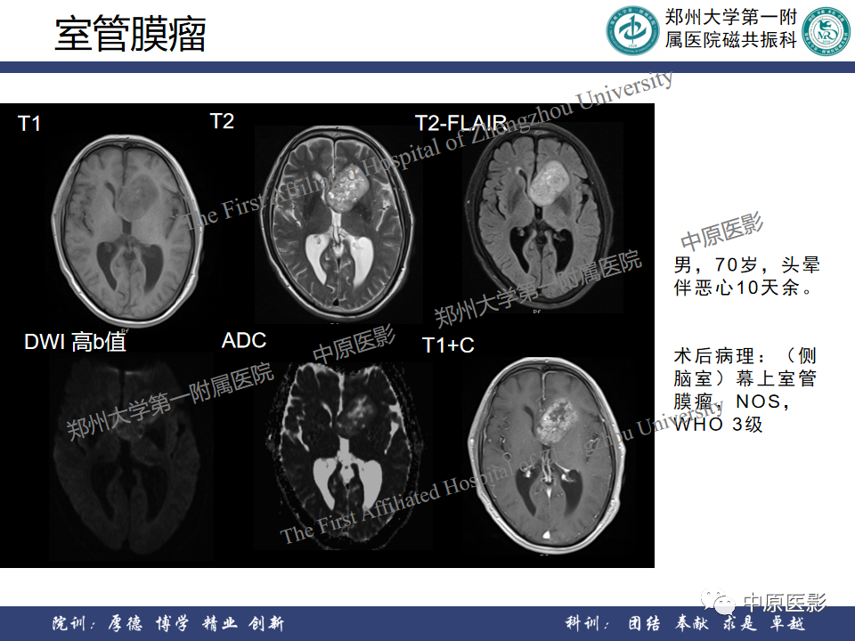 影像PPT - 【病例】侧脑室胶质母细胞瘤1例MR影像-21