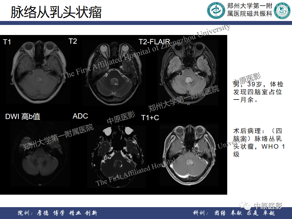 影像PPT - 【病例】侧脑室胶质母细胞瘤1例MR影像-24