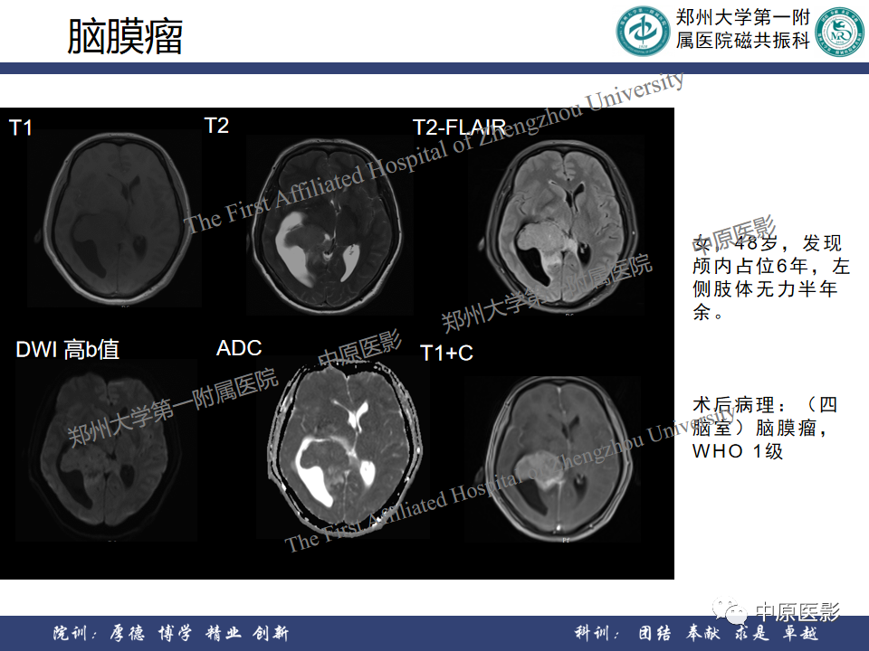 影像PPT - 【病例】侧脑室胶质母细胞瘤1例MR影像-26