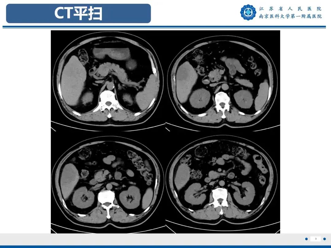 影像PPT - 【PPT】细菌性肝脓肿-4