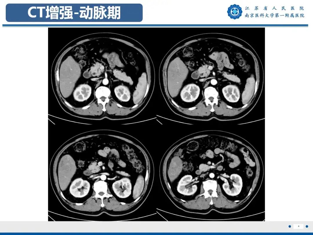 影像PPT - 【PPT】细菌性肝脓肿-5
