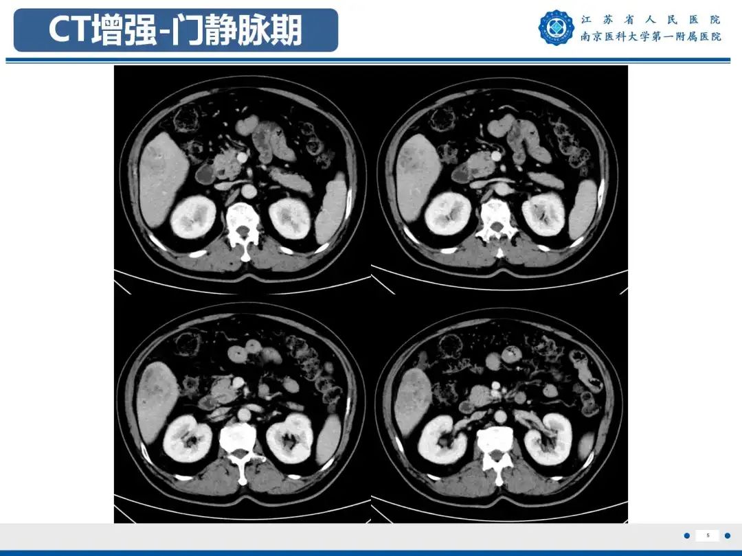 影像PPT - 【PPT】细菌性肝脓肿-6