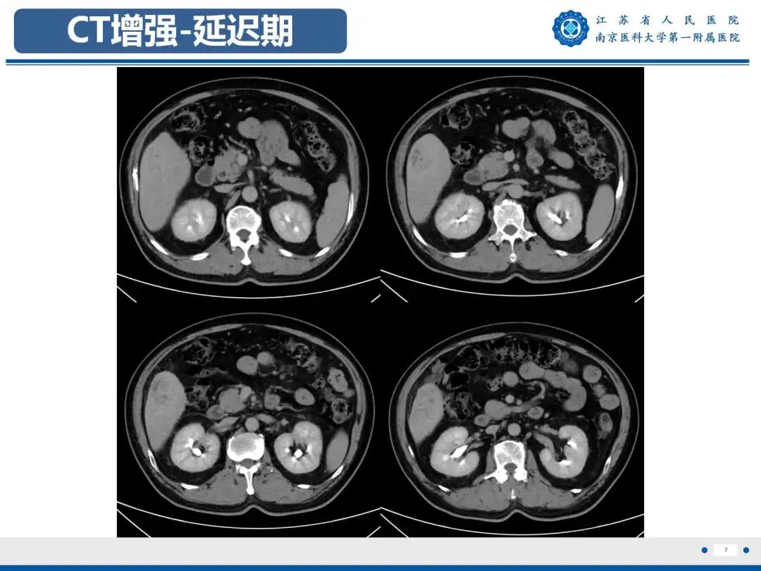 影像PPT - 【PPT】细菌性肝脓肿-8