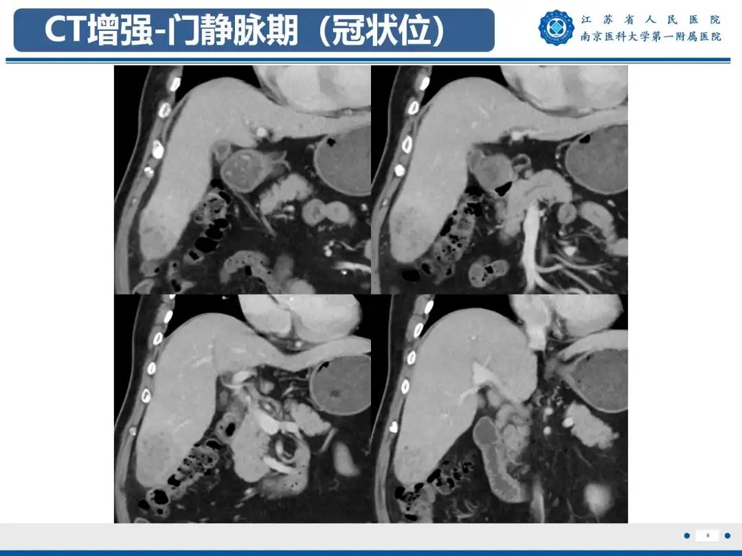 影像PPT - 【PPT】细菌性肝脓肿-7