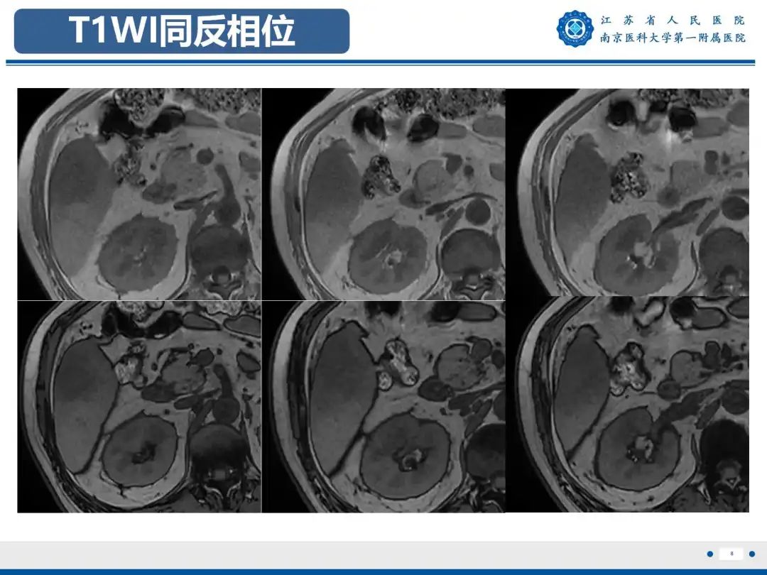 影像PPT - 【PPT】细菌性肝脓肿-9