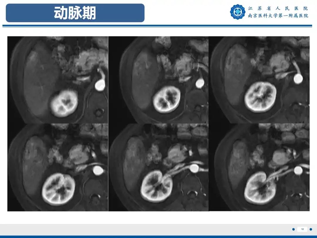 影像PPT - 【PPT】细菌性肝脓肿-13