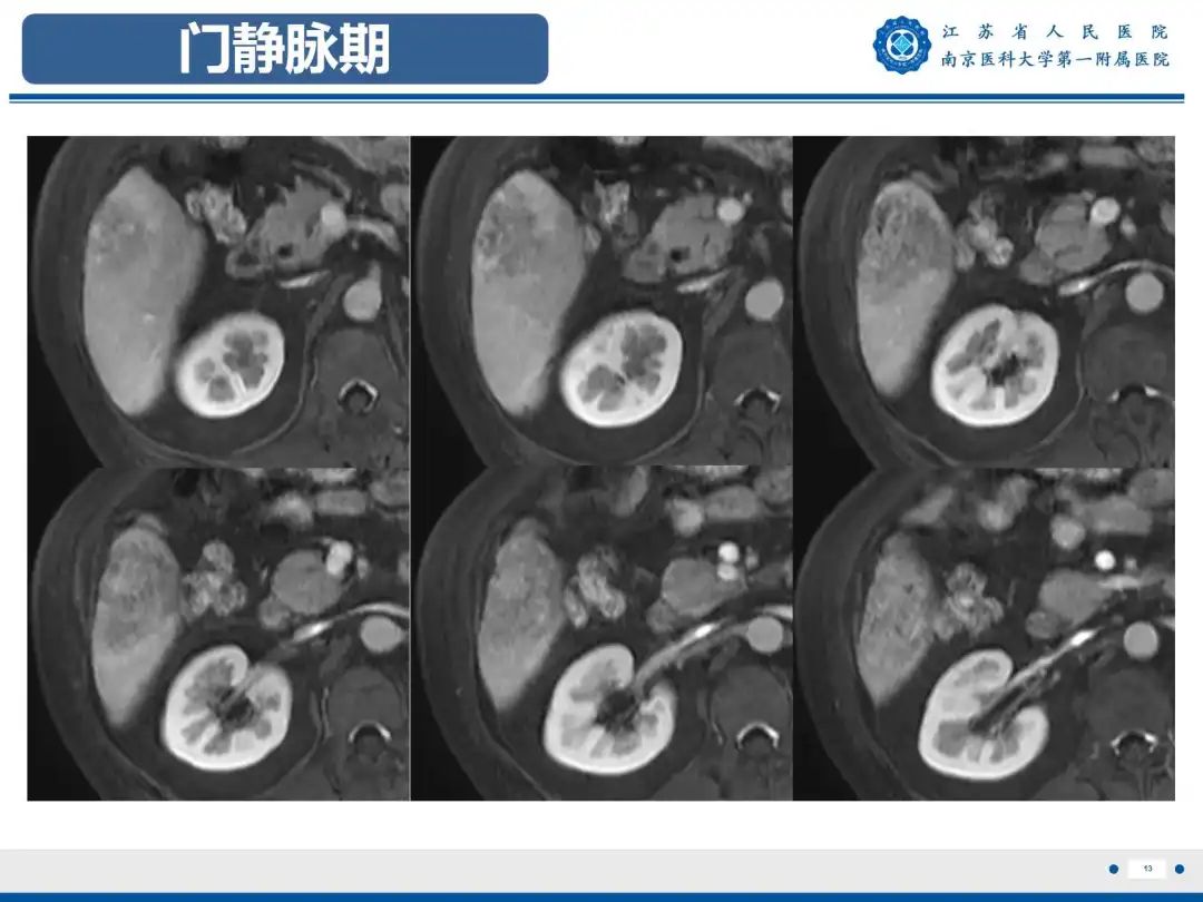 影像PPT - 【PPT】细菌性肝脓肿-14