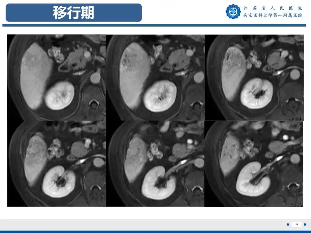 影像PPT - 【PPT】细菌性肝脓肿-15