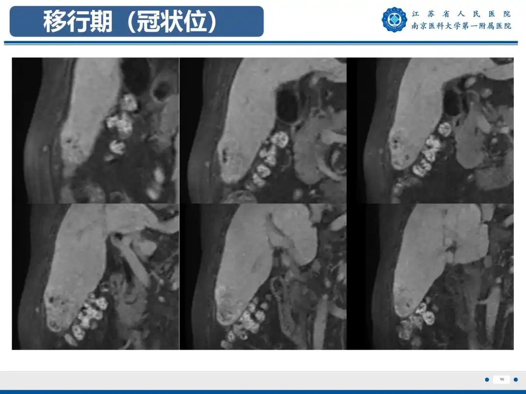 影像PPT - 【PPT】细菌性肝脓肿-16