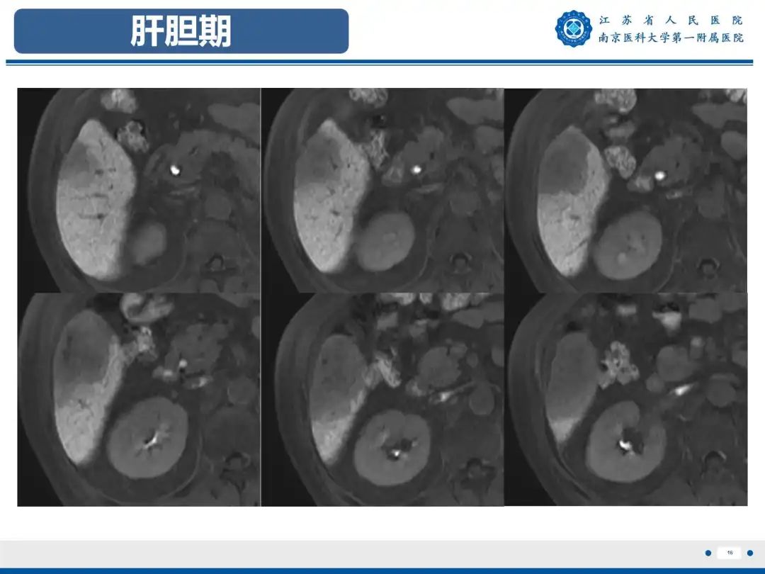 影像PPT - 【PPT】细菌性肝脓肿-17