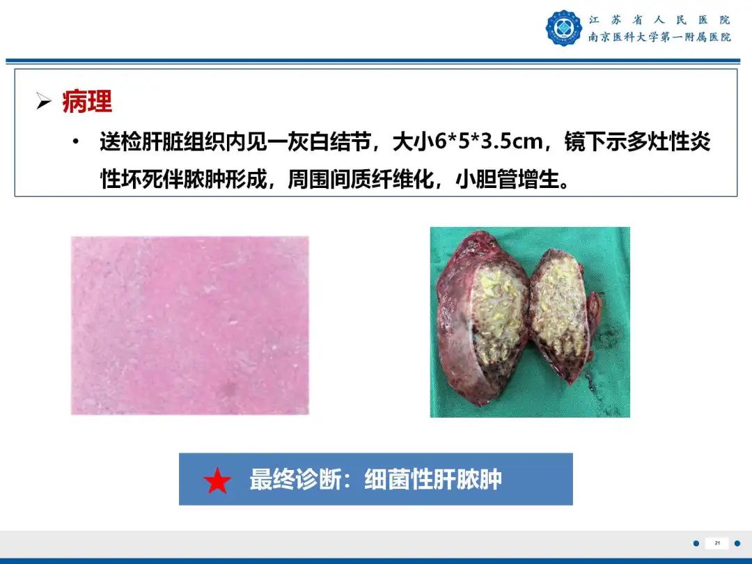 影像PPT - 【PPT】细菌性肝脓肿-22