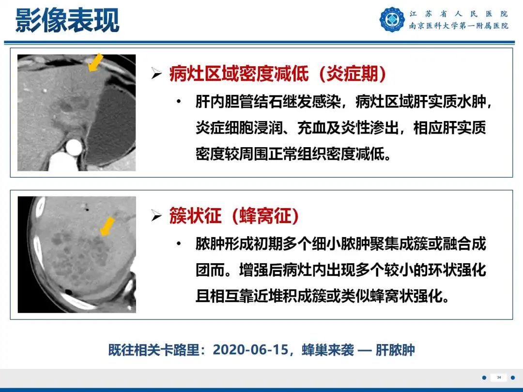 影像PPT - 【PPT】细菌性肝脓肿-35