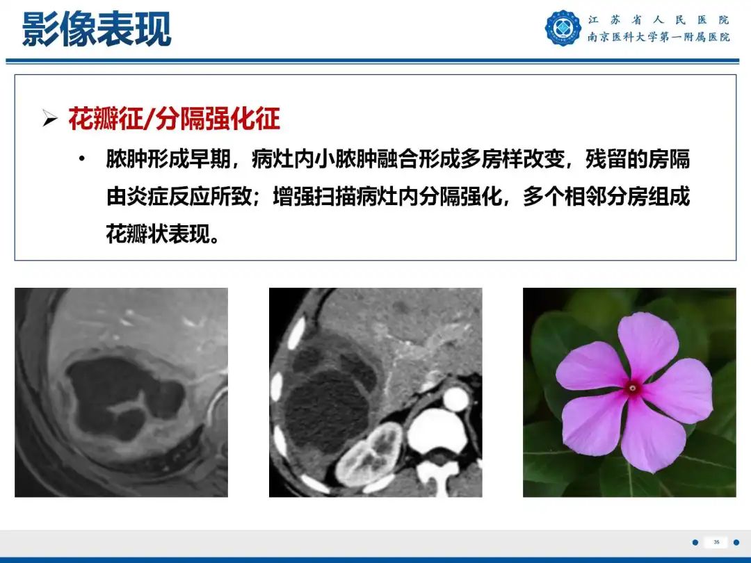 影像PPT - 【PPT】细菌性肝脓肿-36