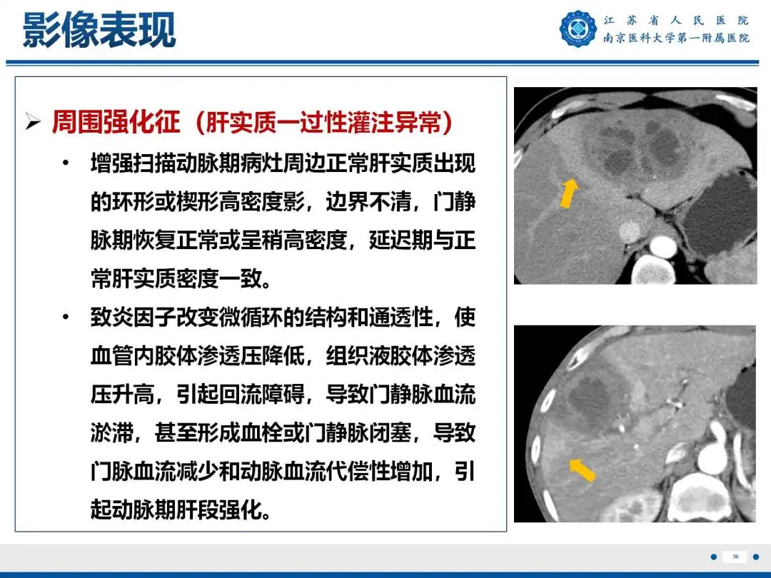 影像PPT - 【PPT】细菌性肝脓肿-37