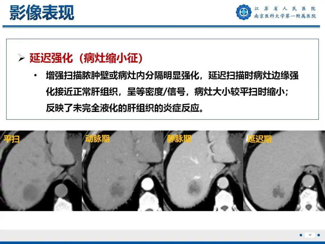 影像PPT - 【PPT】细菌性肝脓肿-38