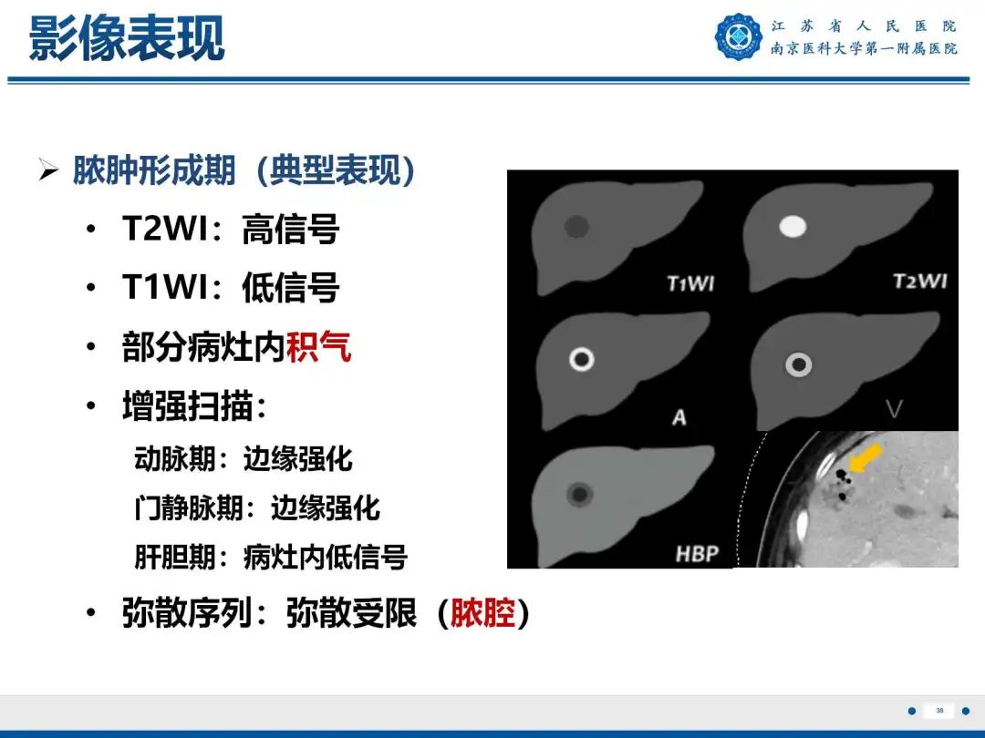 影像PPT - 【PPT】细菌性肝脓肿-39