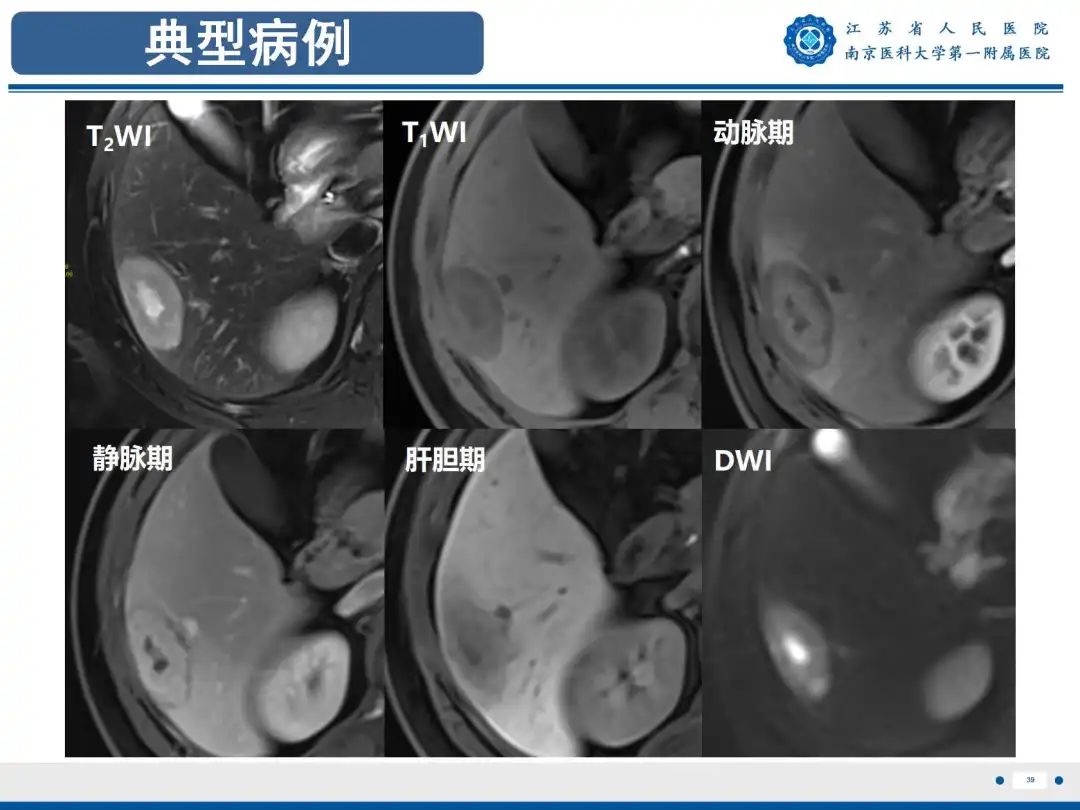 影像PPT - 【PPT】细菌性肝脓肿-40