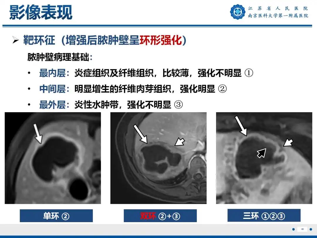 影像PPT - 【PPT】细菌性肝脓肿-41