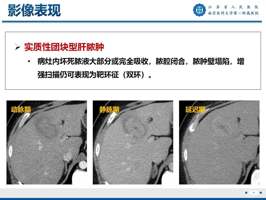 影像PPT - 【PPT】细菌性肝脓肿-42