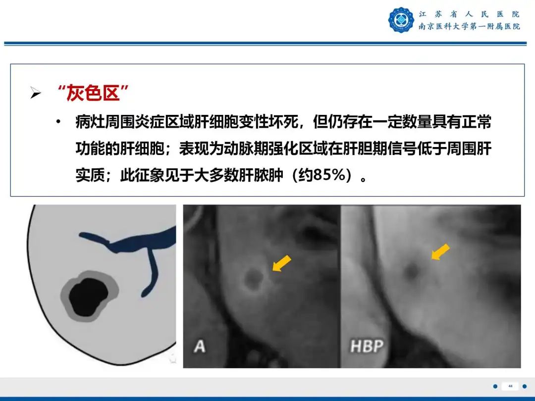 影像PPT - 【PPT】细菌性肝脓肿-45