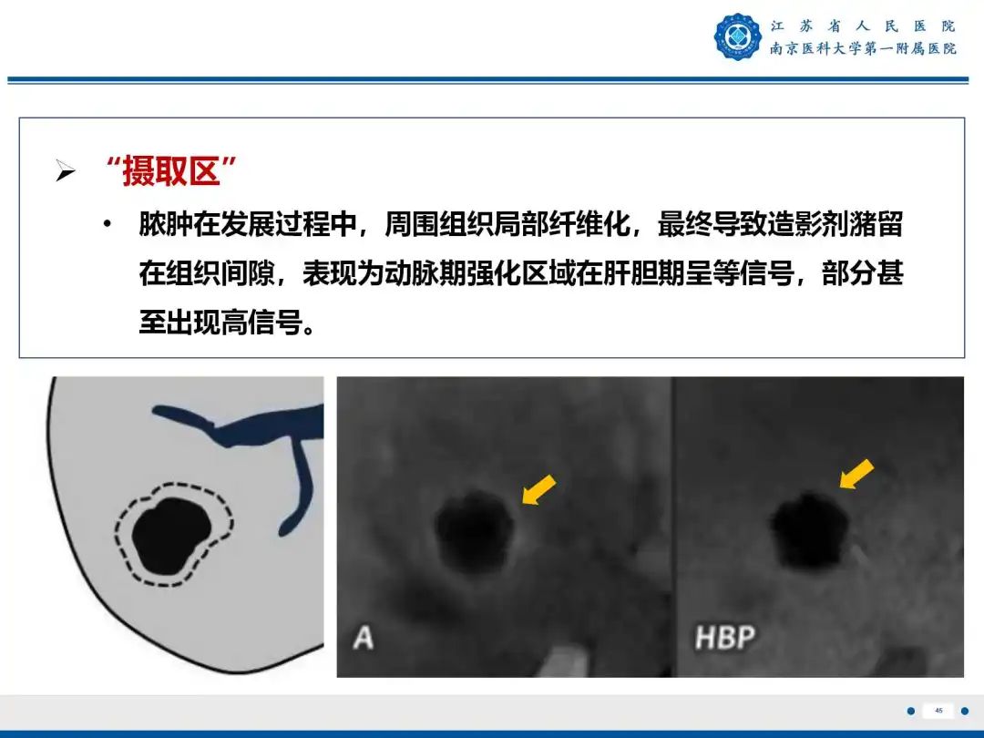 影像PPT - 【PPT】细菌性肝脓肿-46