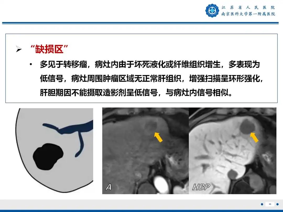 影像PPT - 【PPT】细菌性肝脓肿-47