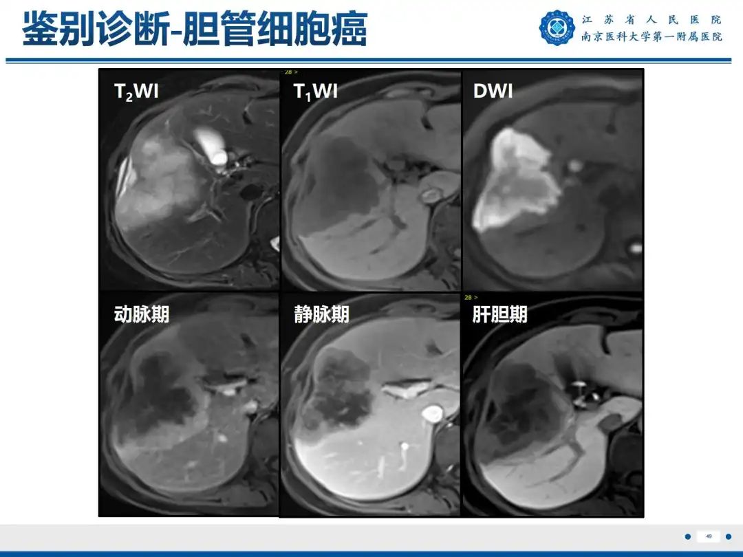 影像PPT - 【PPT】细菌性肝脓肿-50