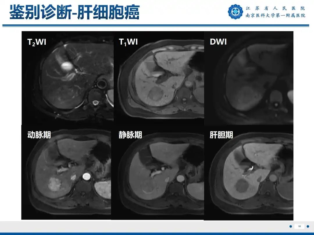 影像PPT - 【PPT】细菌性肝脓肿-53