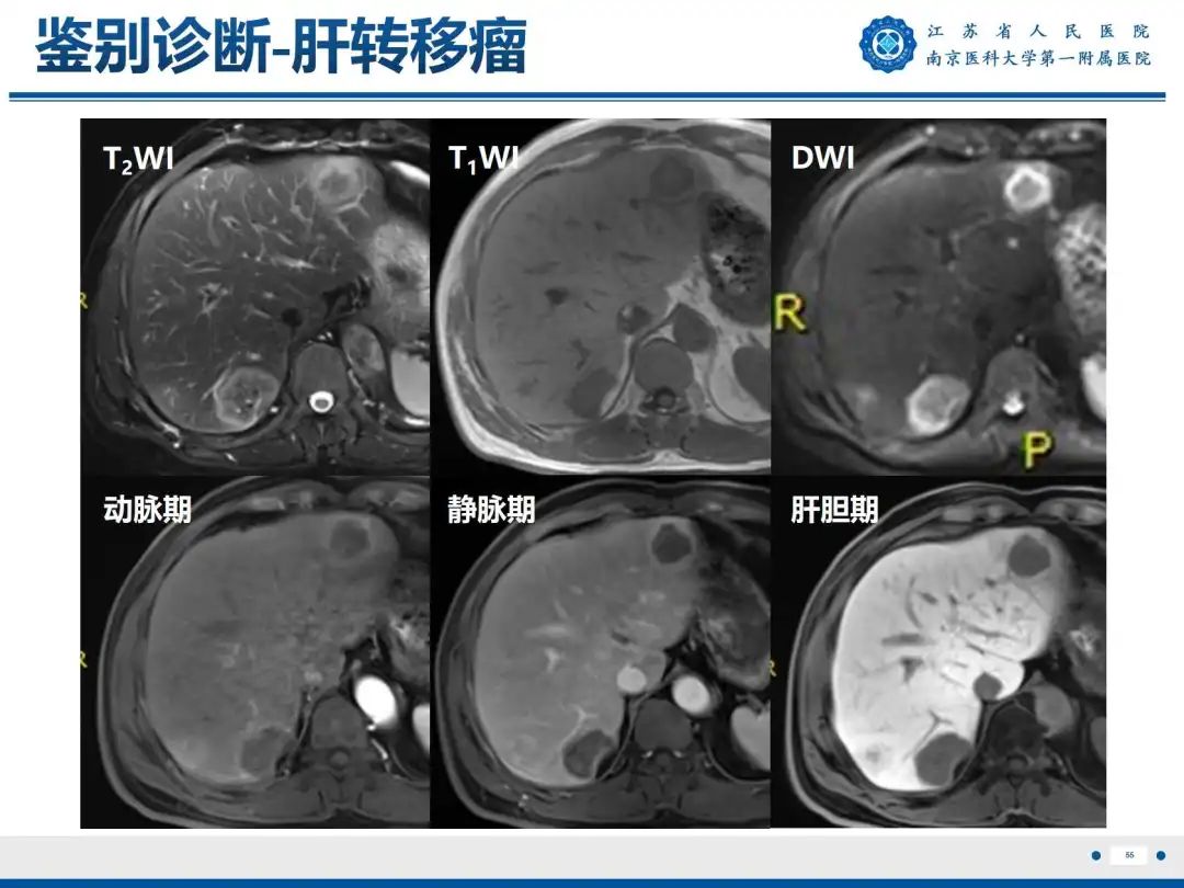 影像PPT - 【PPT】细菌性肝脓肿-56