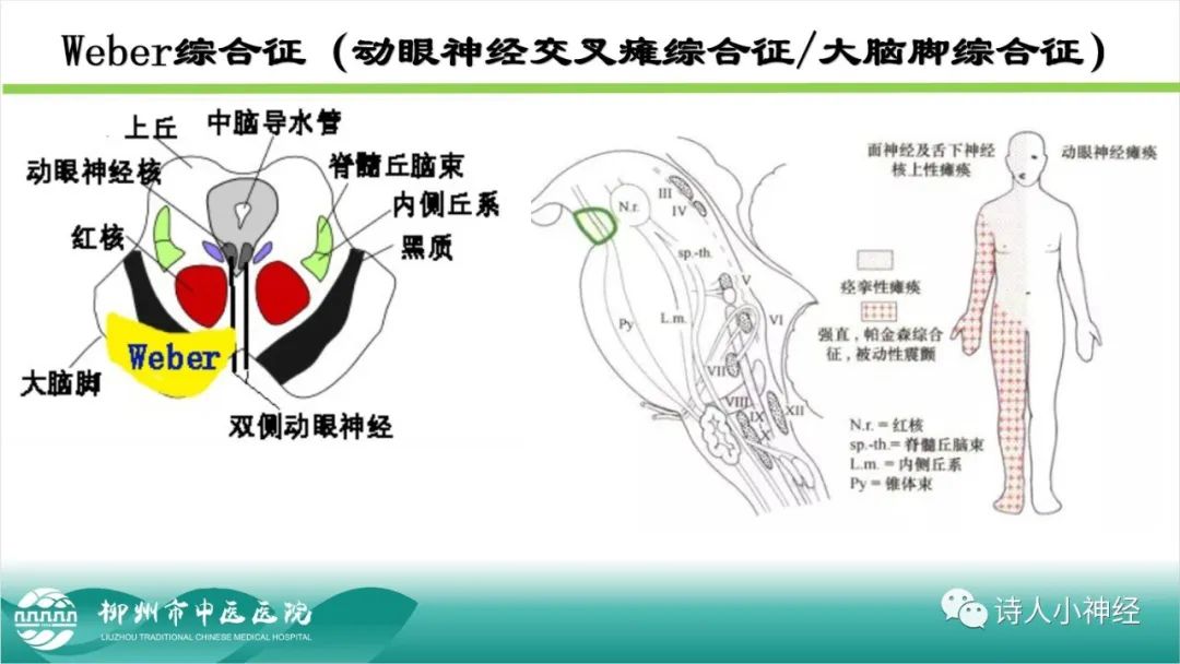 影像PPT - 【PPT】各种脑干梗死综合征临床解剖及影像-5