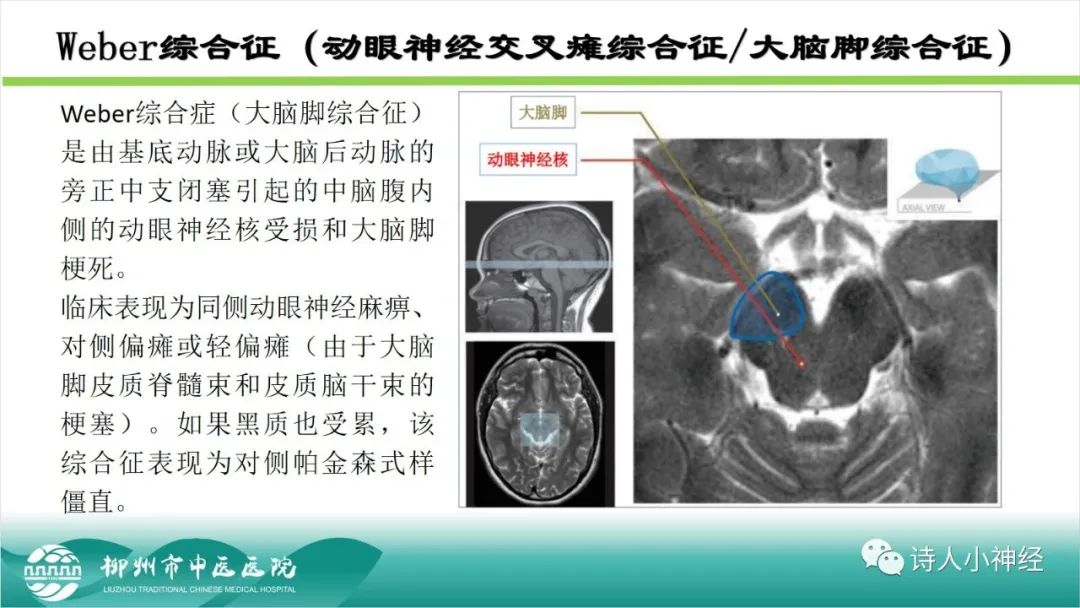 影像PPT - 【PPT】各种脑干梗死综合征临床解剖及影像-6