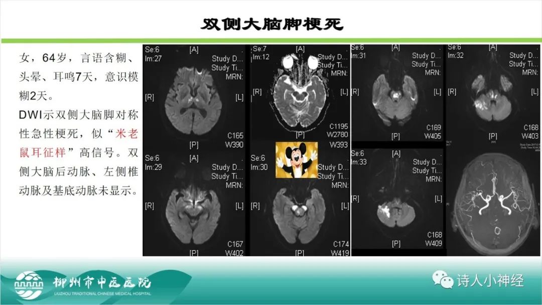 影像PPT - 【PPT】各种脑干梗死综合征临床解剖及影像-16