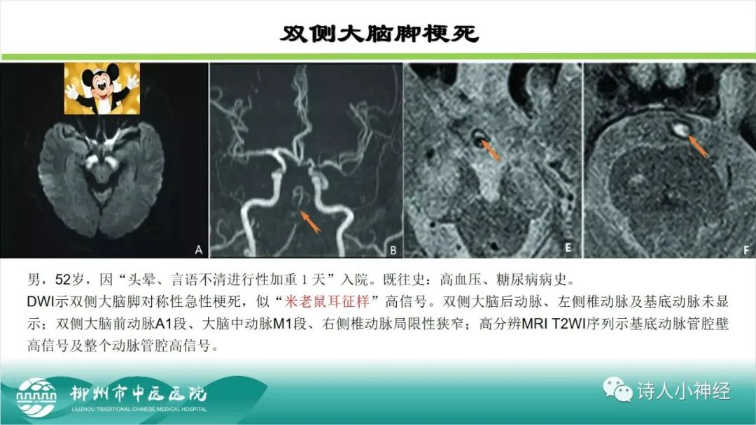 影像PPT - 【PPT】各种脑干梗死综合征临床解剖及影像-15