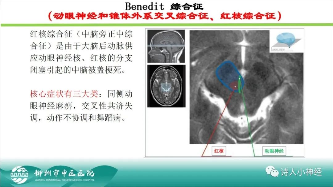 影像PPT - 【PPT】各种脑干梗死综合征临床解剖及影像-18