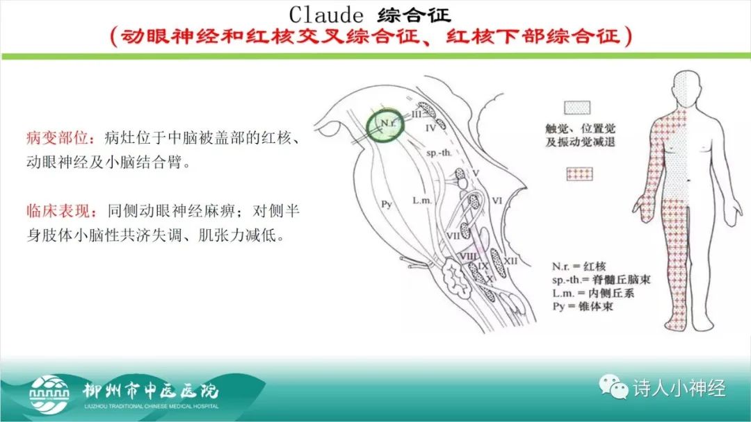 影像PPT - 【PPT】各种脑干梗死综合征临床解剖及影像-20