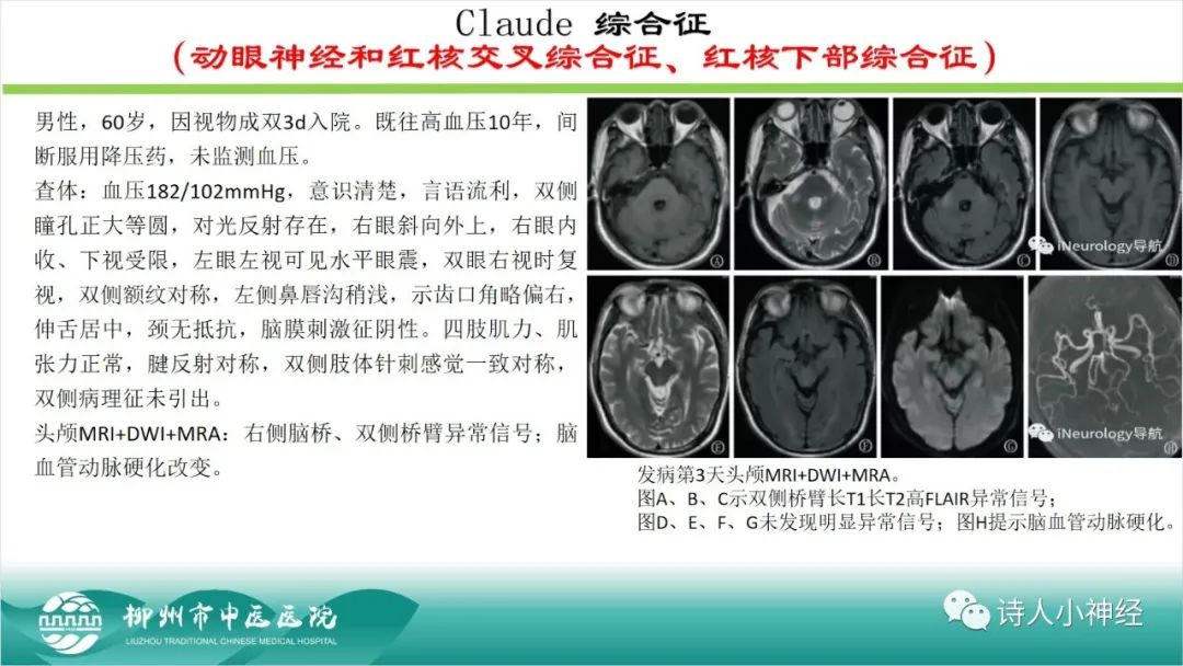 影像PPT - 【PPT】各种脑干梗死综合征临床解剖及影像-22