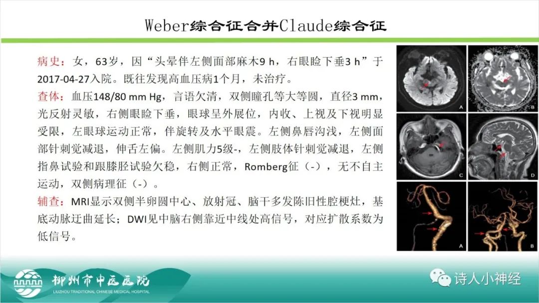 影像PPT - 【PPT】各种脑干梗死综合征临床解剖及影像-24