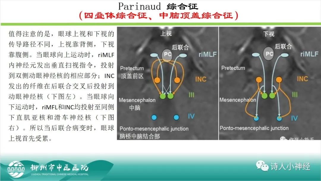 影像PPT - 【PPT】各种脑干梗死综合征临床解剖及影像-27