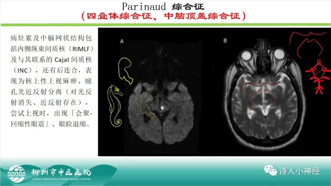 影像PPT - 【PPT】各种脑干梗死综合征临床解剖及影像-29