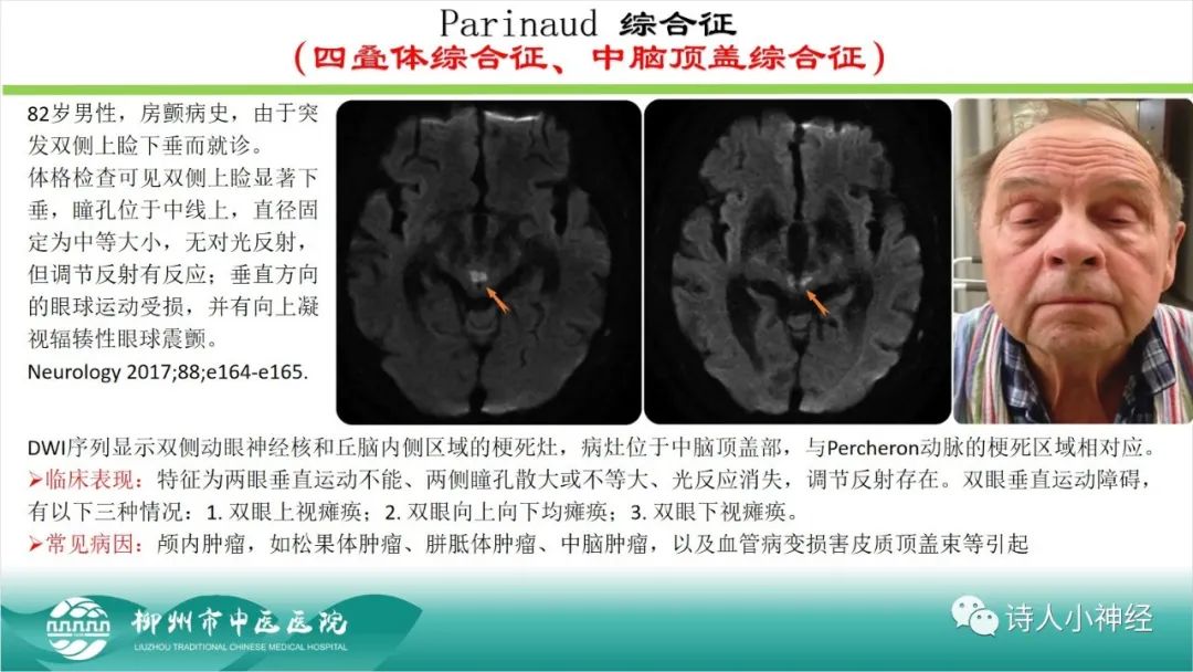 影像PPT - 【PPT】各种脑干梗死综合征临床解剖及影像-30