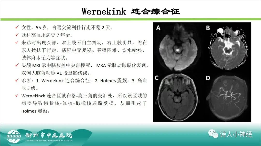 影像PPT - 【PPT】各种脑干梗死综合征临床解剖及影像-34