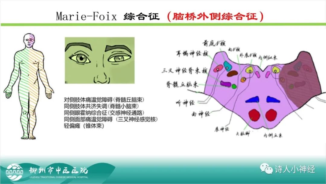 影像PPT - 【PPT】各种脑干梗死综合征临床解剖及影像-39